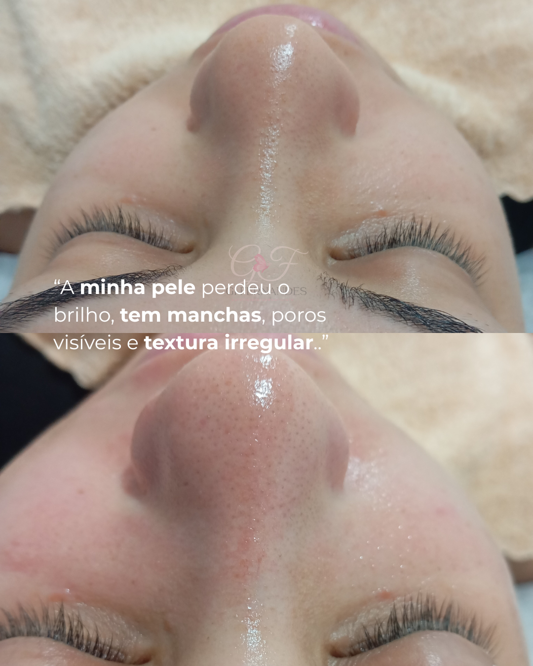 Protocolo facial — brilho, textura e poros