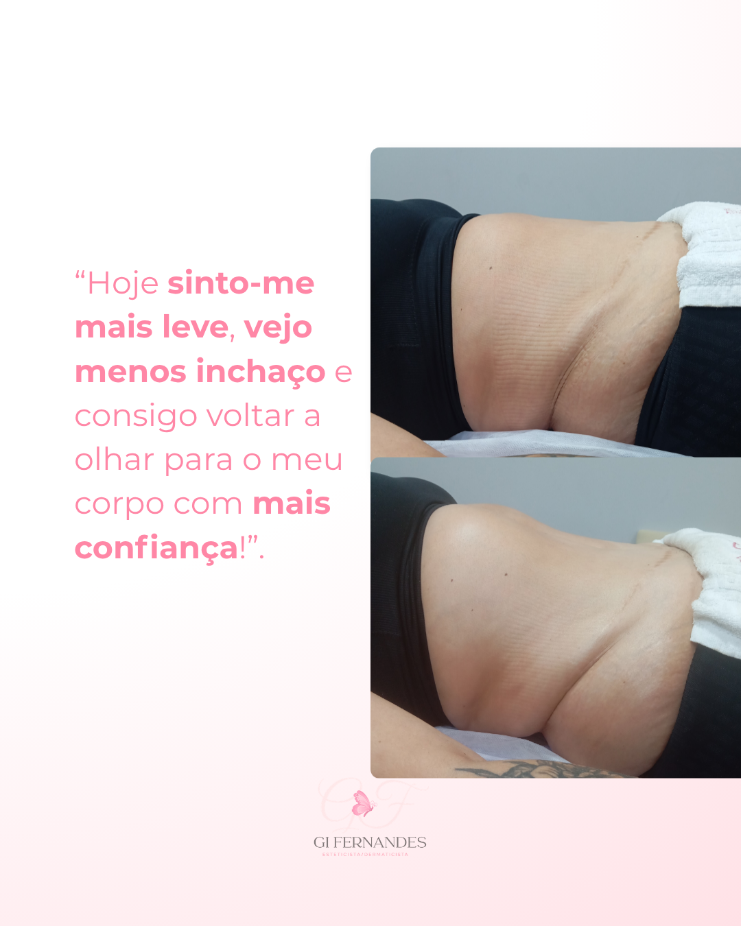 Drenagem abdominal — menos inchaço e mais leveza