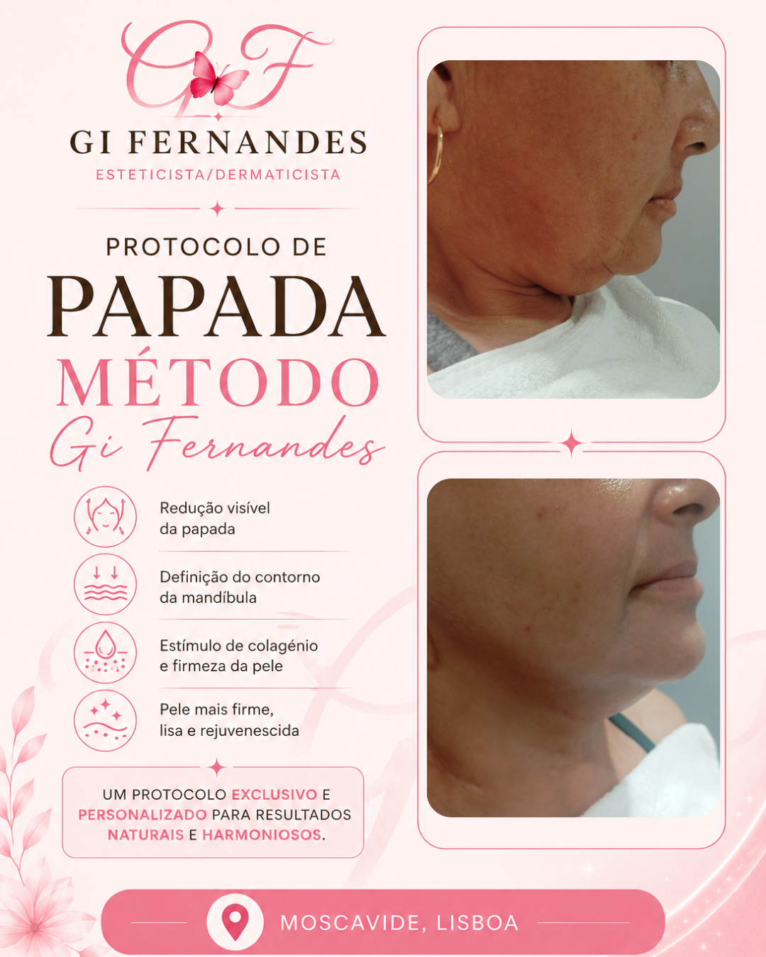 Protocolo de papada — antes e depois